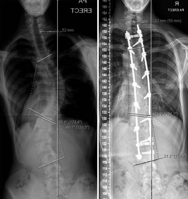 Sindrome de Marfan Paganini